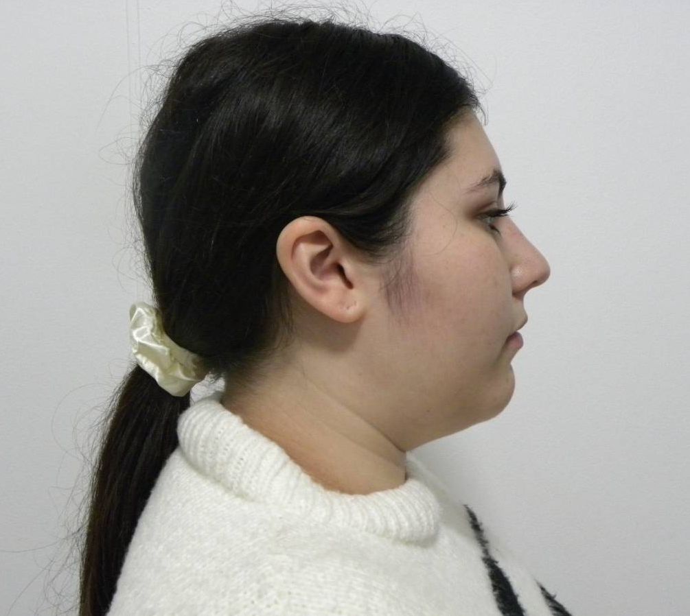Lateral estricta derecha
