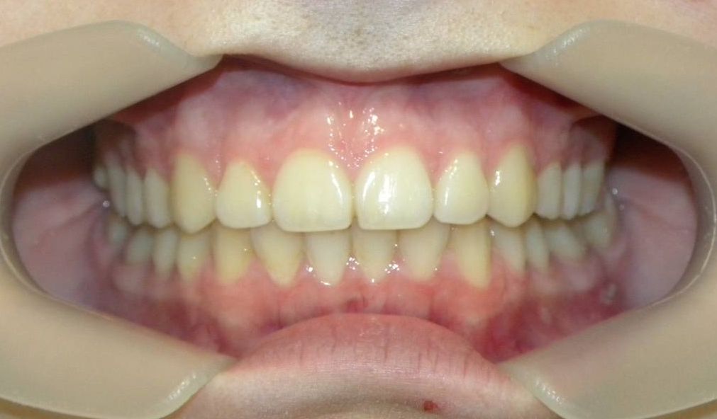 Frontal (Oclusión)