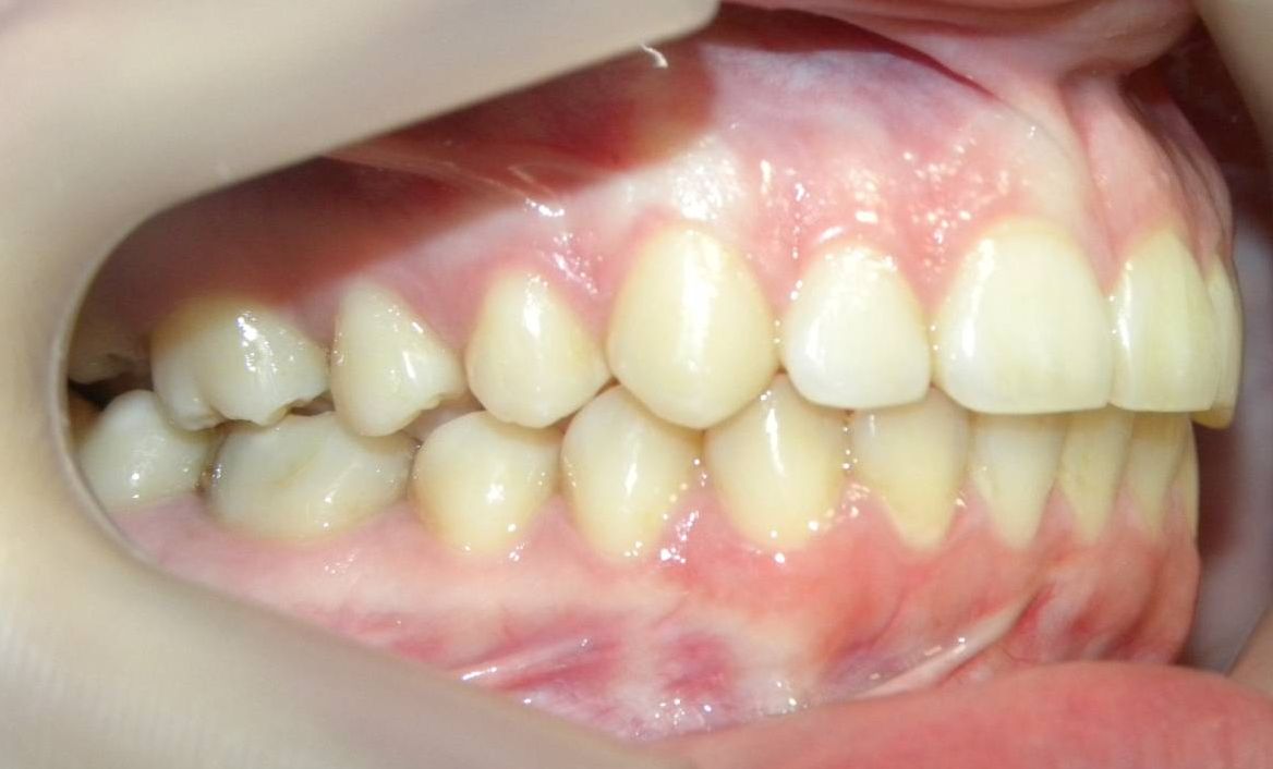 Lateral Derecha