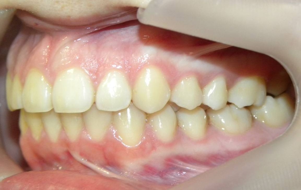 Lateral Izquierda