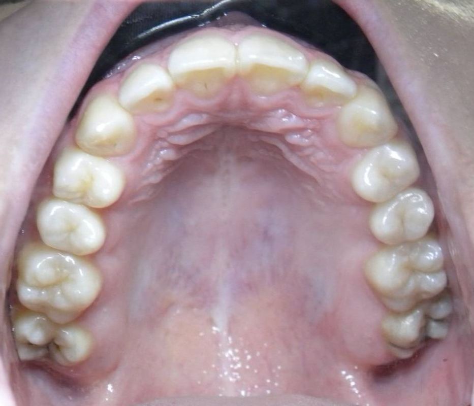 Oclusal Superior
