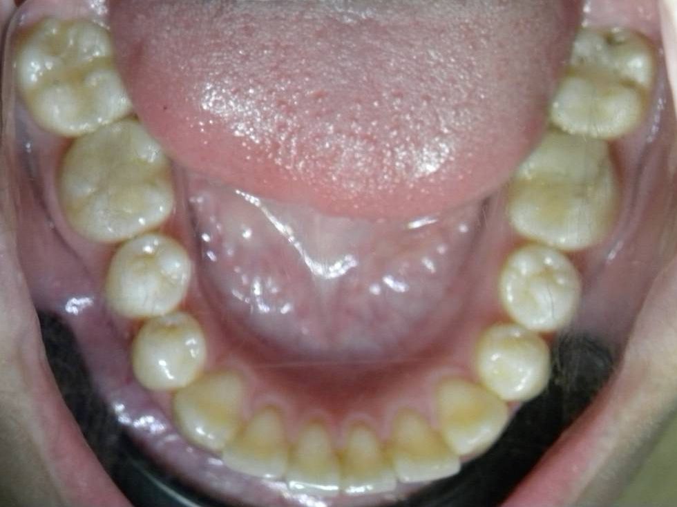 Oclusal Inferior
