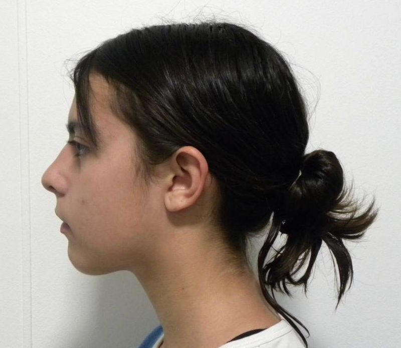 Lateral estricta izquierda
