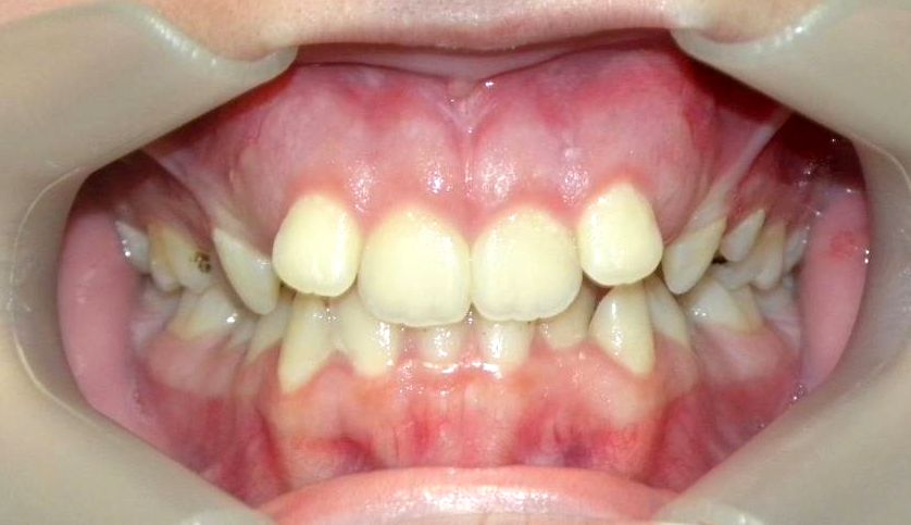 Frontal (Oclusión)