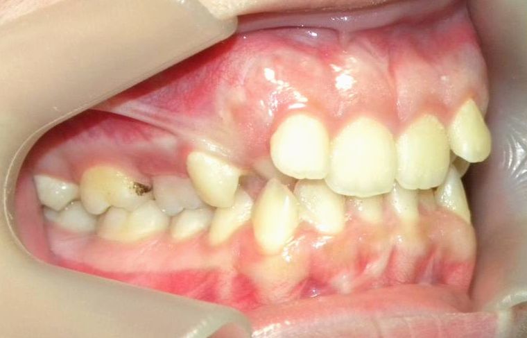 Lateral Derecha