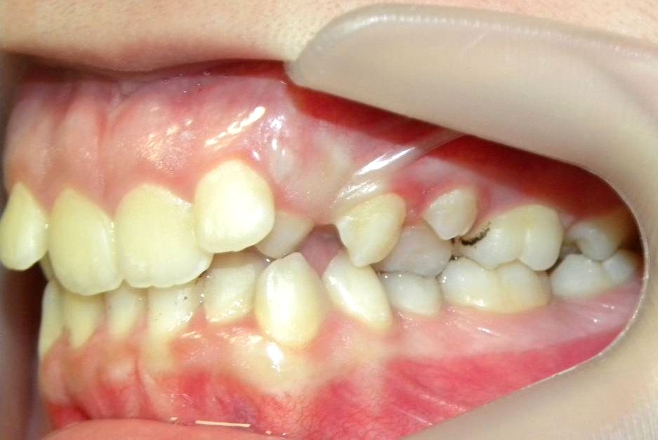 Lateral Izquierda