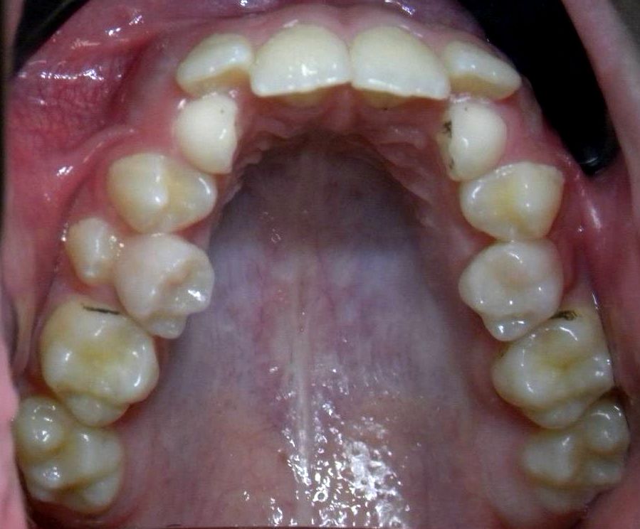 Oclusal Superior