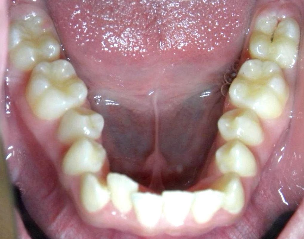 Oclusal Inferior