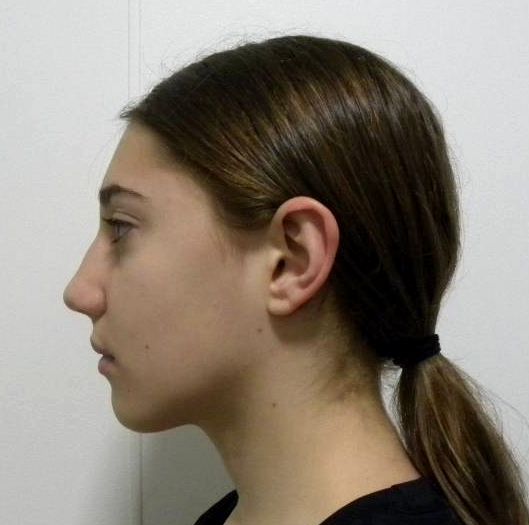 Lateral estricta izquierda