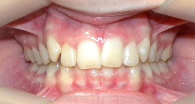 Frontal (Oclusión)