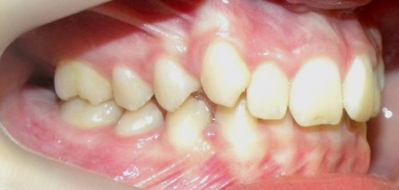 Lateral Derecha