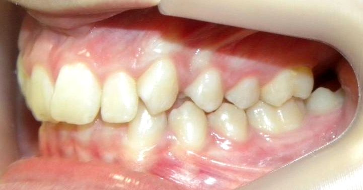 Lateral Izquierda