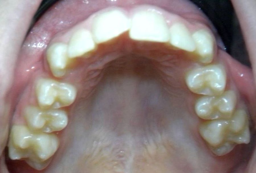 Oclusal Superior