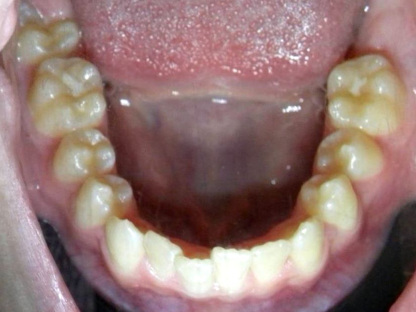 Oclusal Inferior