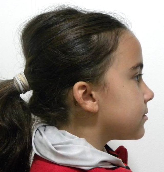 Lateral estricta derecha