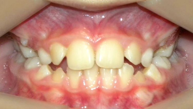 Frontal (Oclusión)