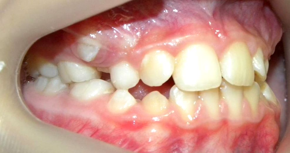 Lateral Derecha