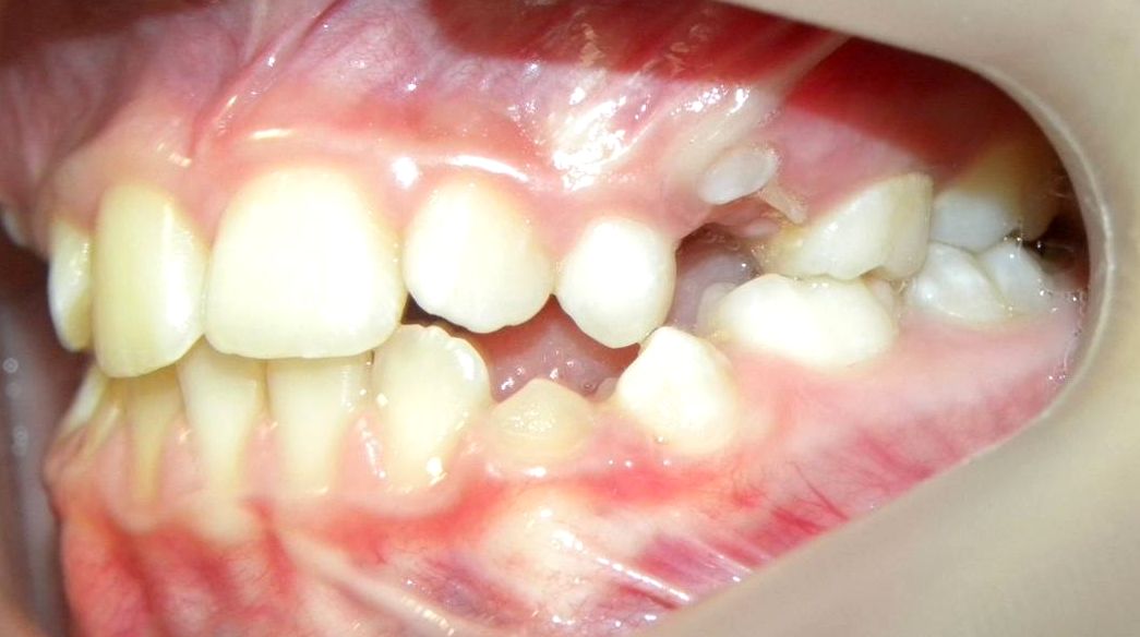 Lateral Izquierda