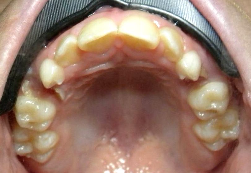 Oclusal Superior