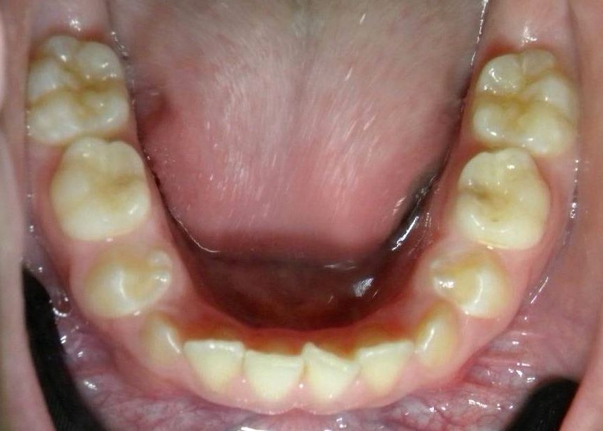 Oclusal Inferior