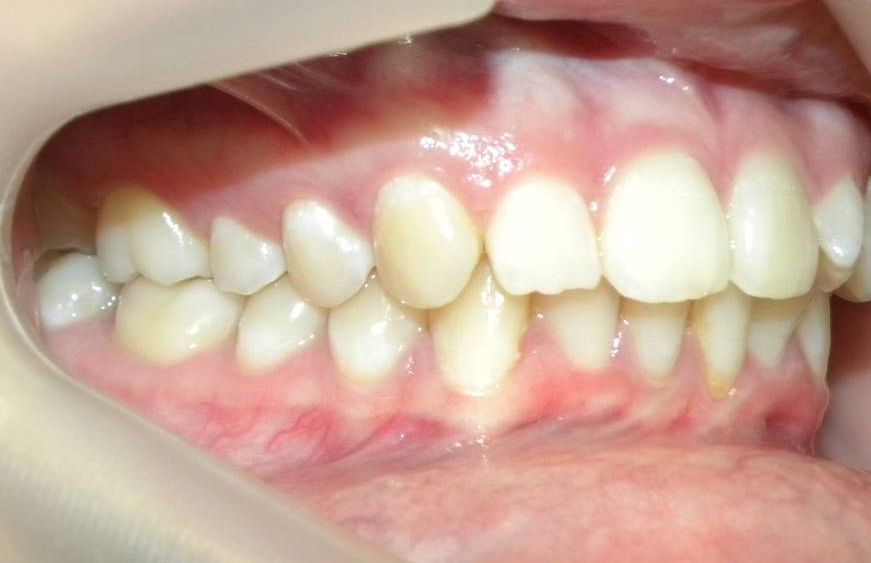 Lateral Derecha