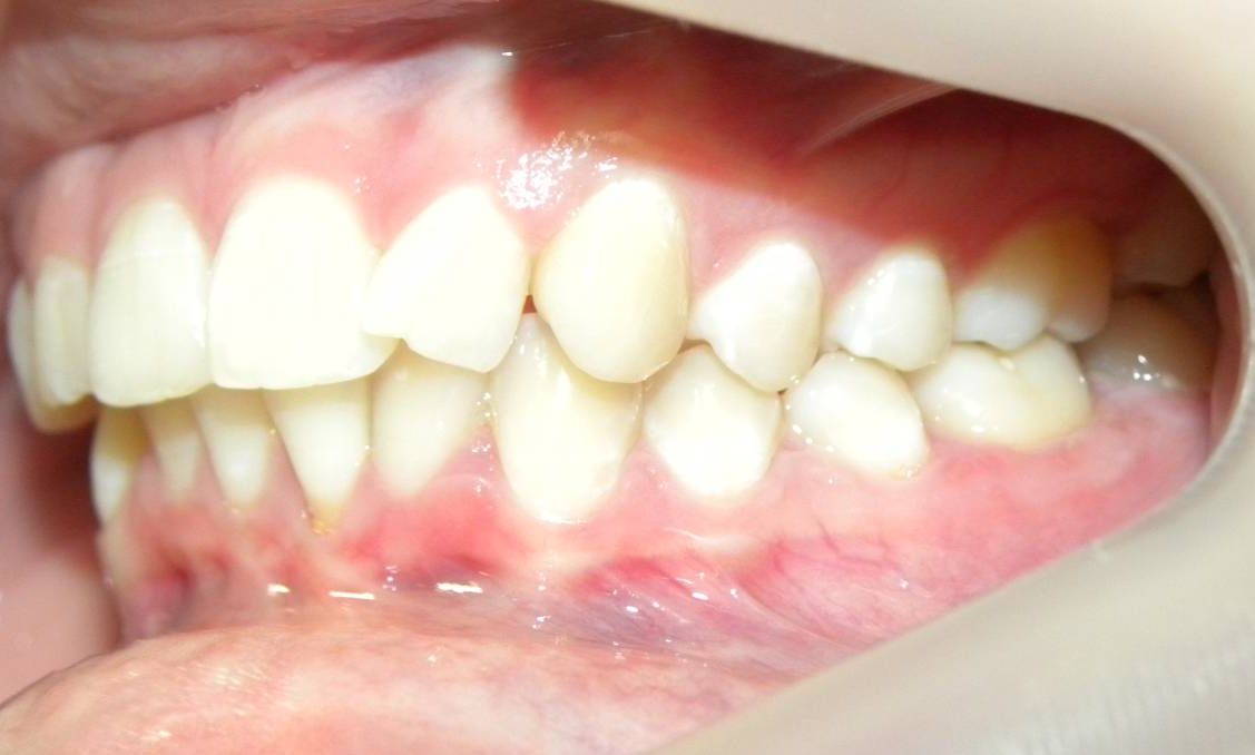 Lateral Izquierda
