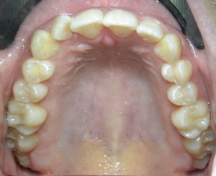 Oclusal Superior
