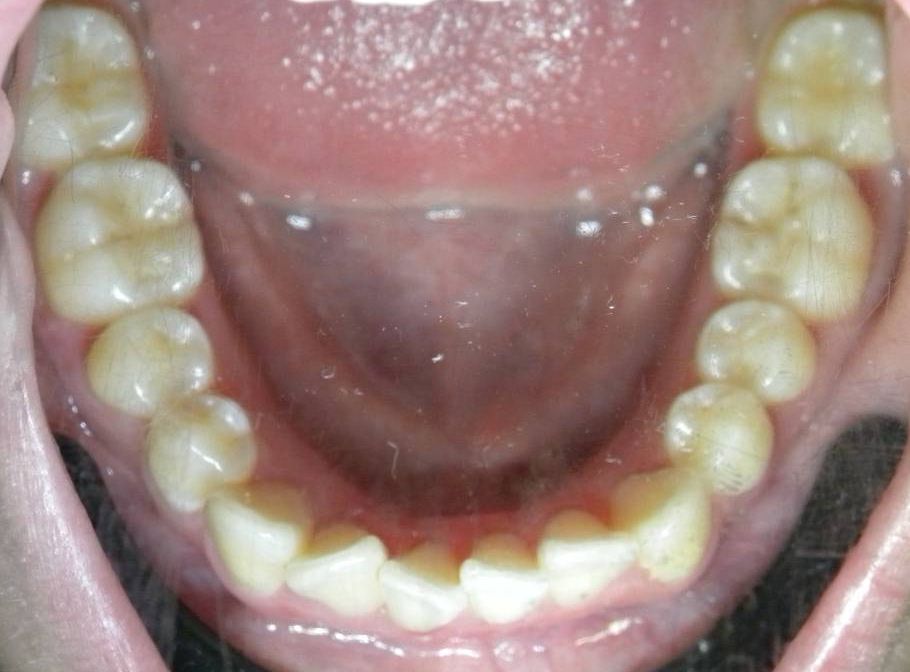 Oclusal Inferior