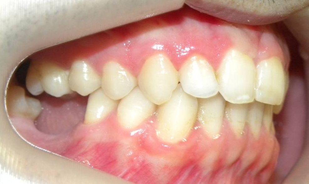 Lateral Derecha