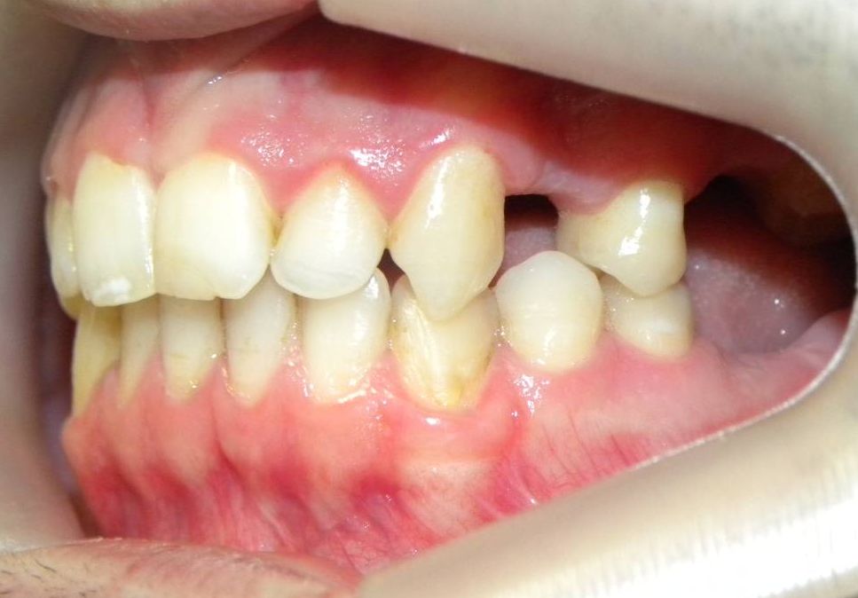 Lateral Izquierda