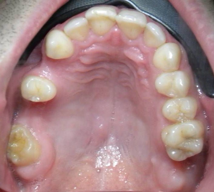 Oclusal Superior