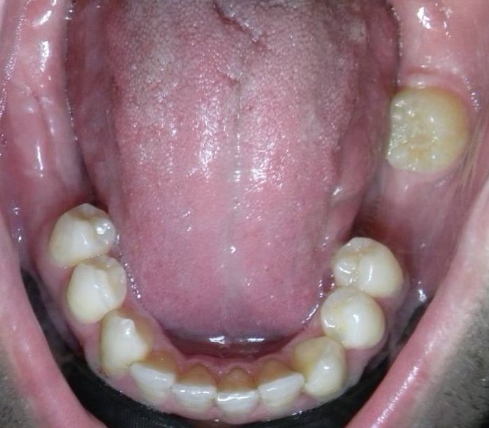 Oclusal Inferior