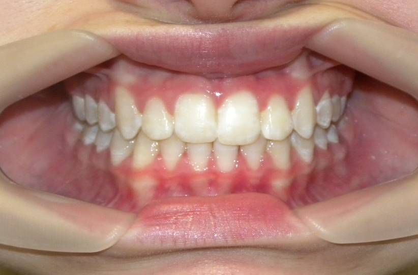 Frontal (Oclusión)
