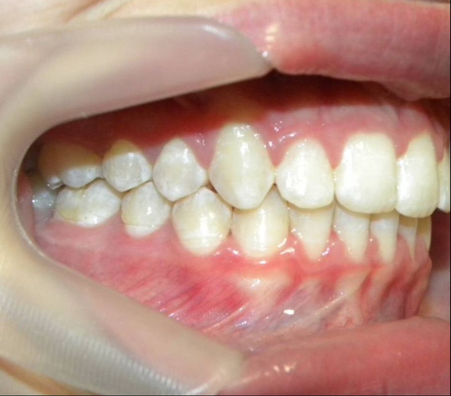 Lateral Derecha