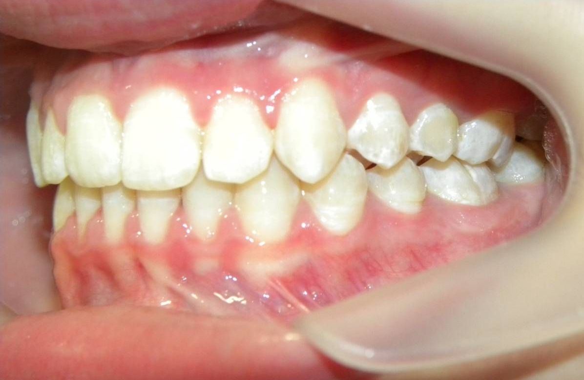 Lateral Izquierda