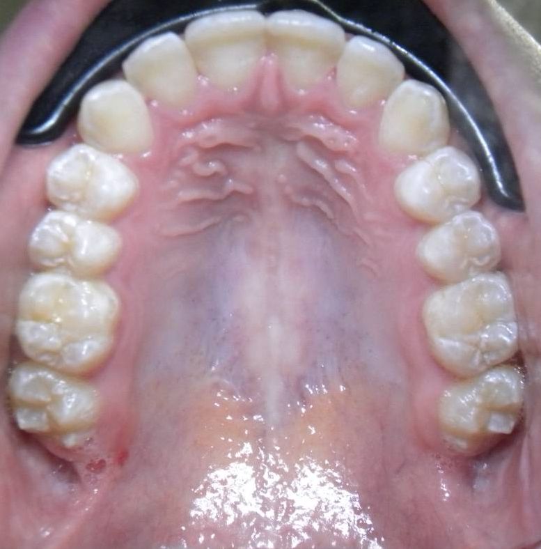 Oclusal Superior