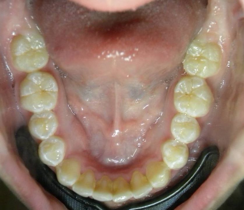 Oclusal Inferior