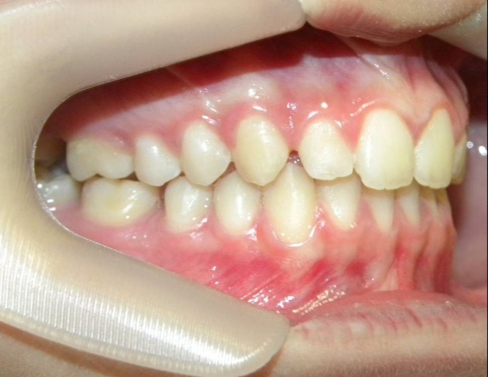 Lateral Derecha