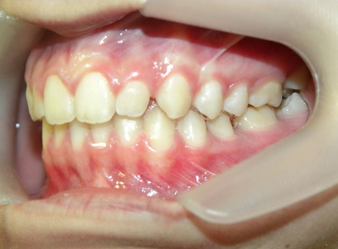 Lateral Izquierda