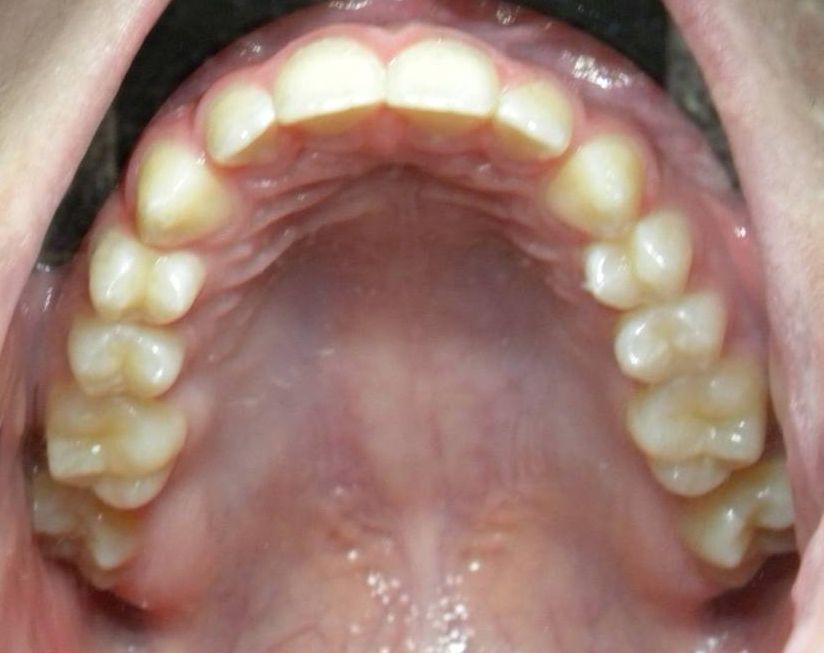 Oclusal Superior