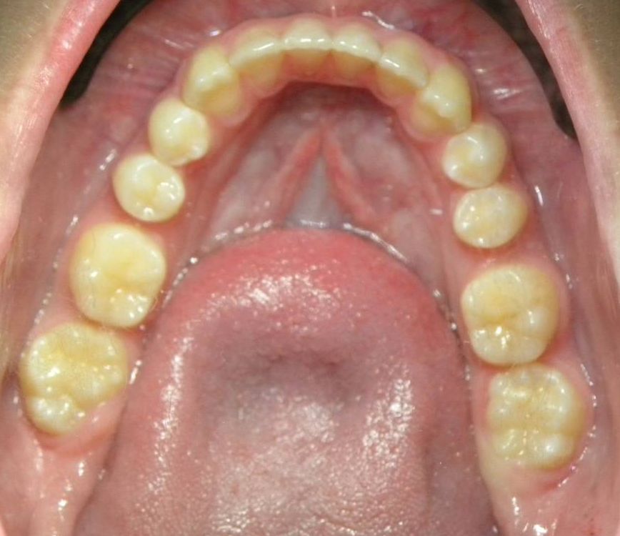 Oclusal Inferior
