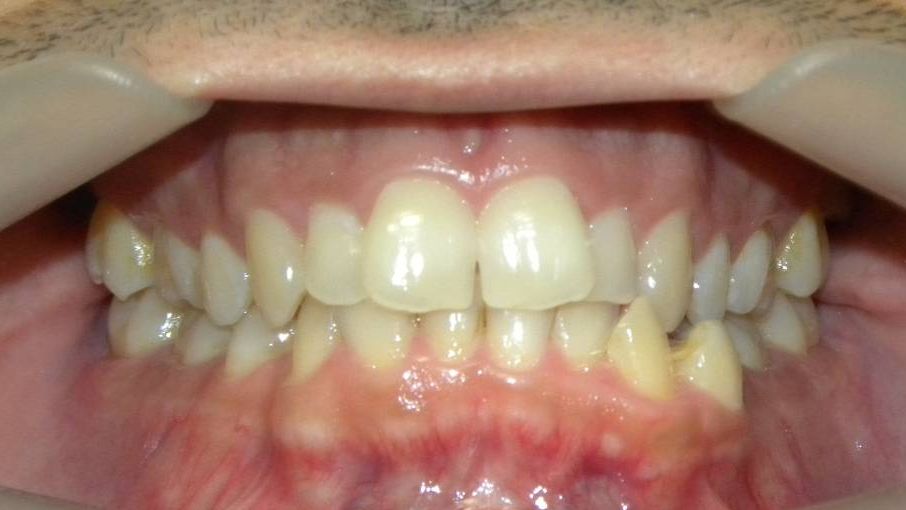 Frontal (Oclusión)