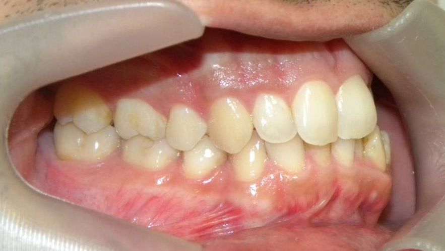 Lateral Derecha
