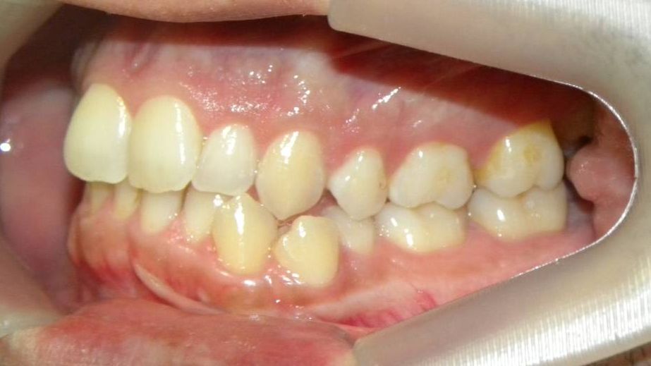 Lateral Izquierda