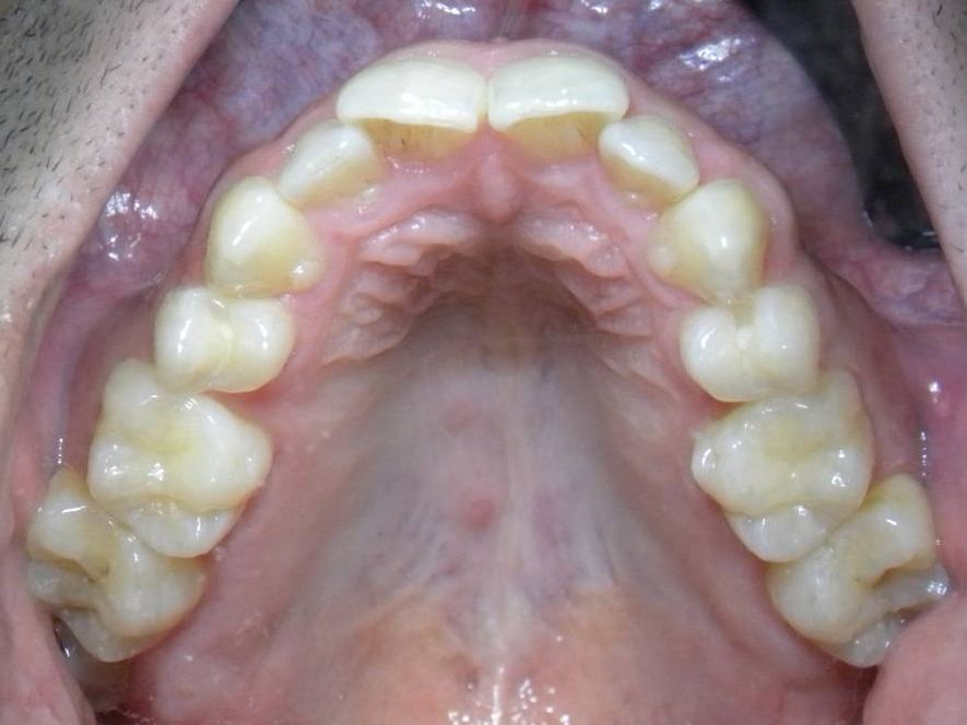Oclusal Superior