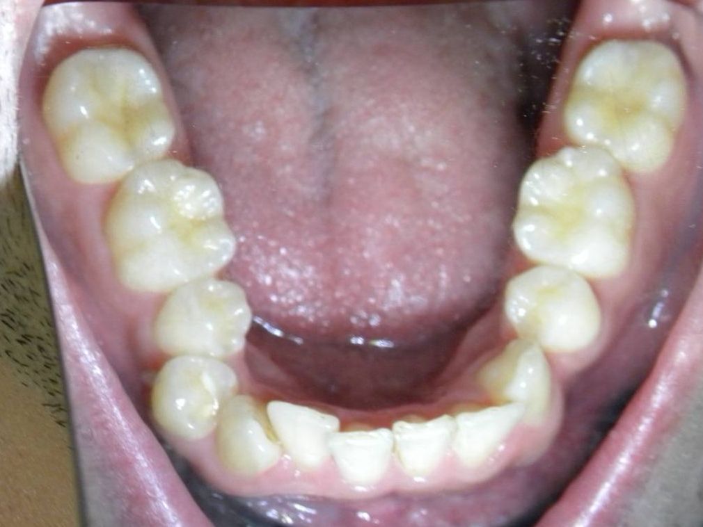 Oclusal Inferior