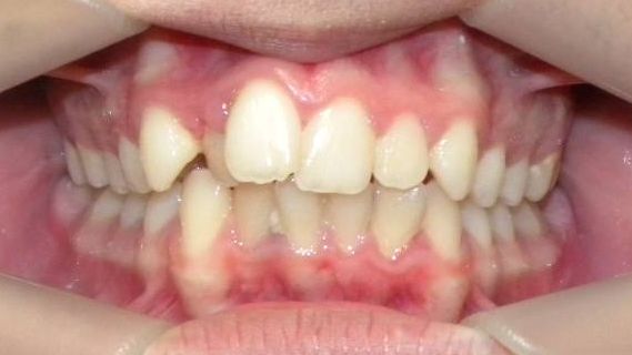 Frontal (Oclusión)