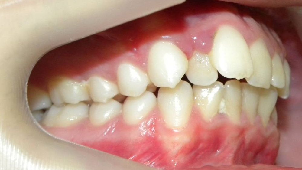 Lateral Derecha