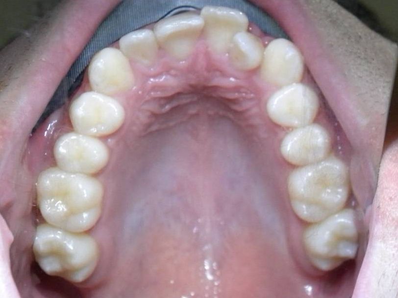 Oclusal Superior