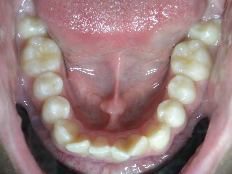 Oclusal Inferior